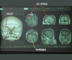 Innovative surgery at the MUB Clinical Hospital's Department of Neurosurgery